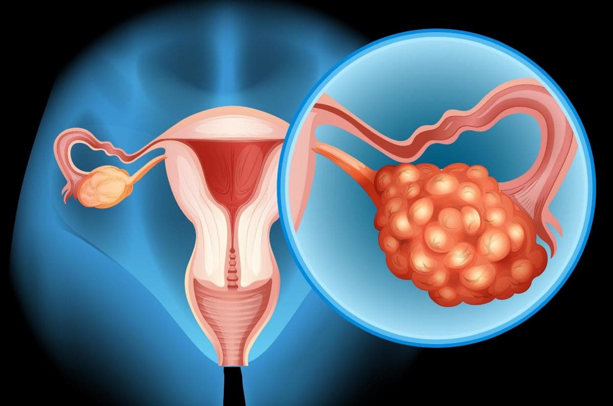 Emergency Ovarian Cancer Treatment Fund
